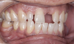 bridge crown - before- Klinik Pergigian Dental Shore