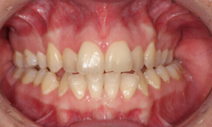 before invisible braces - Klinik Pergigian Dental Shore