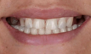 before denture - Klinik Pergigan Dental Shore