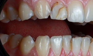 before dental veneer - klinik pergigian dental shore