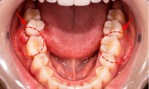 before wisdom teeth removal - klinik pergigian dental shore