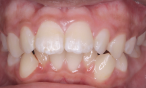 conventional braces treatment (before) - Klinik Pergigian Dental Shore