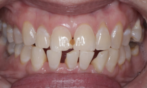 before filling - Klinik Pergigian Dental Shore