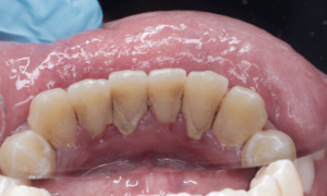 scaling and polishing before - Klinik Pergigian Dental Shore