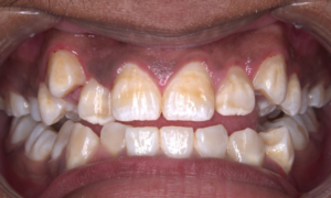 before self ligating braces - Klinik Pergigian Dental Shore