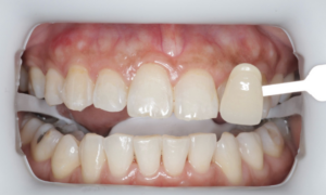 before whitening - Klinik Pergigan Dental Shore