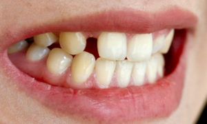 before dental implant - Klinik Pergigian Dental Shore