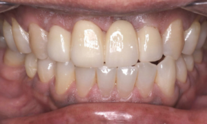 bridge crown - after - Klinik Pergigian Dental Shore