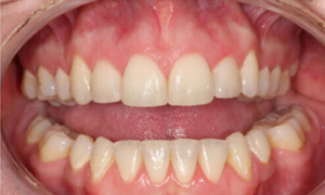 after invisible braces - Klinik Pergigian Dental Shore