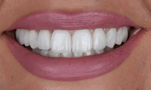 after denture - Klinik Pergigan Dental Shore