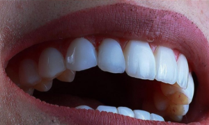 after dental veneer - klinik pergigian dental shore