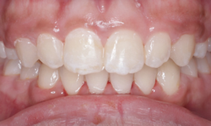 conventional braces treatment (after) - Klinik Pergigian Dental Shore