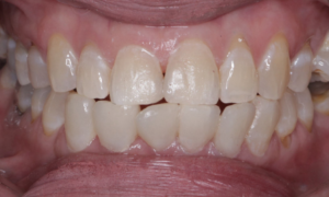 after filling - Klinik Pergigian Dental Shore