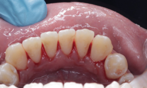 scaling and polishing after - Klinik Pergigian Dental Shore