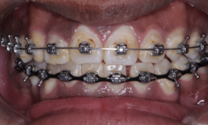 after self ligating braces - Klinik Pergigian Dental Shore