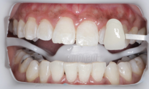 after whitening - Klinik Pergigan Dental Shore