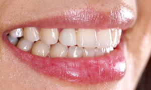 after dental implant - Klinik Pergigian Dental Shore