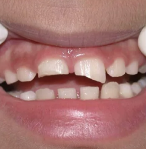 before pediatric dentistry - klinik pergigian dental shore